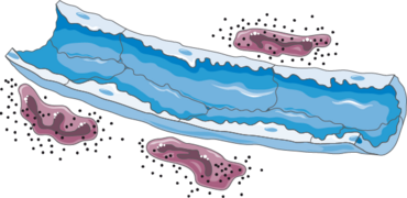 Cardiovascular system - Oedema 3 -- Smart-Servier.png