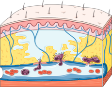 Cardiovascular system - Oedema 4 -- Smart-Servier.png