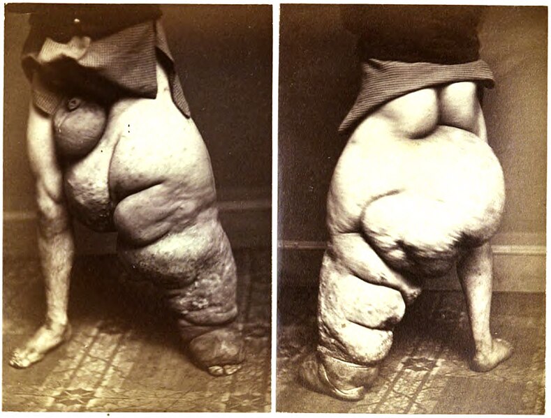 File:Elephantiasis arabum.jpg