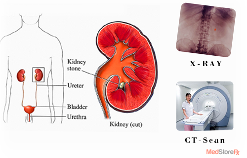 Kidney Stone