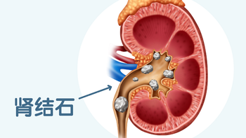 震惊！为什么越来越多的人得肾结石？赶紧听听劝告吧，这2个习惯千万要改掉！