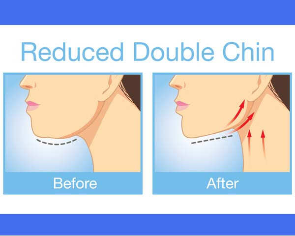 exercises to get rid of a double chin