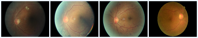 Proliferative DR 2