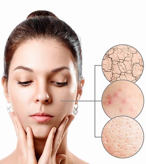 Skin Care Remedies, Dry Skin Acne, Remove Skin Tags Naturally, Dry Skin On Face, Natural Skin Care Remedies, Natural Acne Remedies, Remove Acne, Acne Remedies, Make Up Look