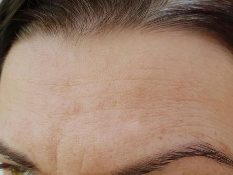 Forehead Wrinkles Remedies, Remove Forehead Wrinkles, Deep Forehead Wrinkles, Facial Wrinkles, Forehead Wrinkles, Exfoliating Cleanser, Acne Marks, Deep Wrinkles, Chemical Peel