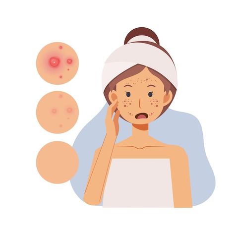 Problem skin concept. woman with pimples... | Premium Vector #Freepik #vector #acne-skin #acne-face #skin-problem #pimple Acne Animation, Skin Problems Face, Acne Drawing, Acne Illustration, Skin Illustration, Back Pimples, Cartoon Character Illustration, Problem Skin, Acne Face