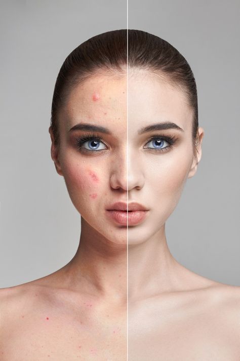 Before And After Acne, Acne Women, Baby Acne, Pimples Under The Skin, Acne Overnight, How To Get Rid Of Pimples, Skin Science, Acne Facial, Petroleum Jelly