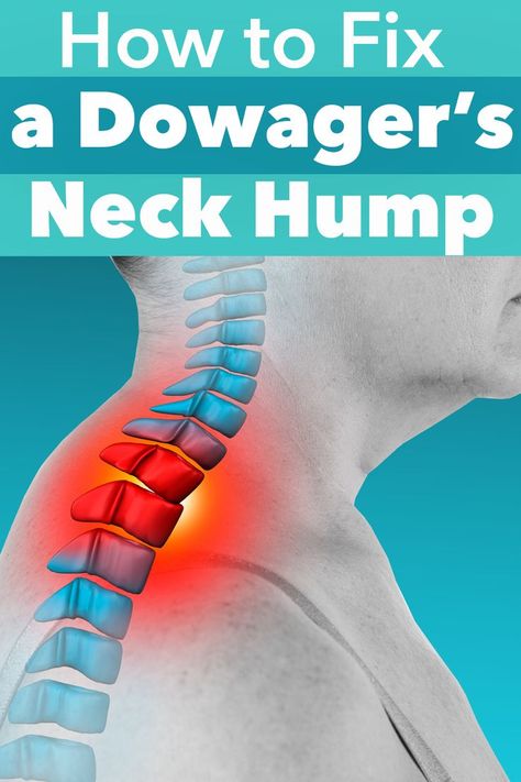 Exercises For Curved Back, Stretches To Help Neck Hump, Humpback Exercise, Dowagers Neck Exercises, Dowagers Hump Correction Exercises, Hump Neck, Mantels Decor, Bad Posture Exercises, Dowagers Hump