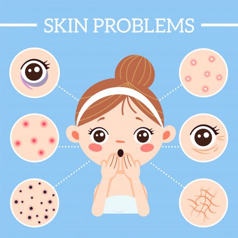 Skin problems infographic Premium Vector | Premium Vector #Freepik #vector #infographic #woman #medical #girl Girl With Acne, Sugary Treats, Skin And Hair Clinic, Acne Problem, Acne Facial, Skincare Quotes, Dark Circles Under Eyes, Women Skin, Acne Blemishes