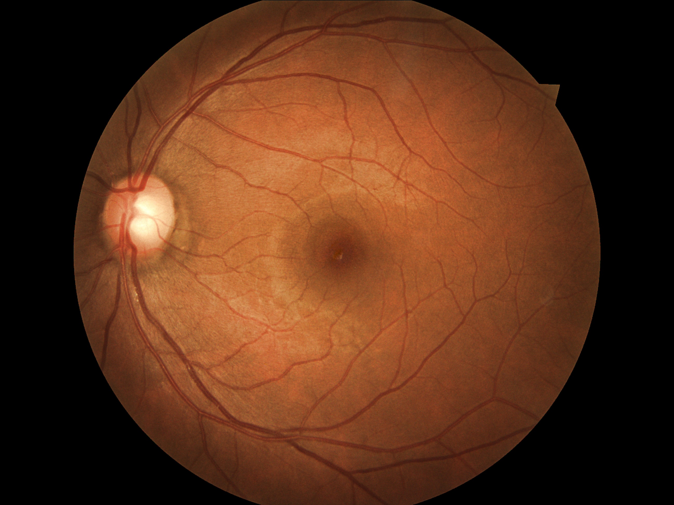 Detecting-diabetic-retinopathy