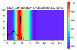 ECG-with-XAI