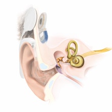 Anatomy Cochlear Implant EAS