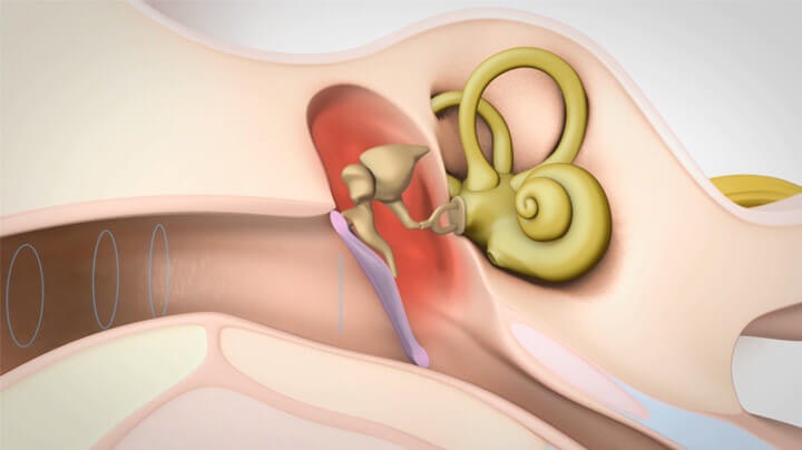 Types of hearing loss